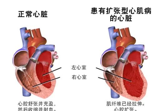 擴張性心肌病嚴(yán)重嗎