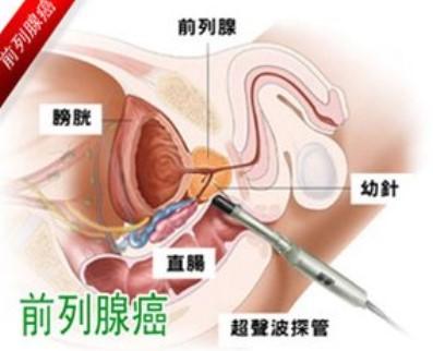 前列腺癌的早期癥狀是什么？