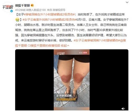 云南女子穿破洞褲7小時(shí)腿被曬傷，溫度30多度紫外線強(qiáng)烈